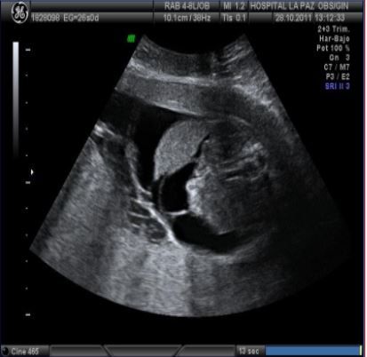 Ecografia de feto de 26 semanas con Hidrops fetal